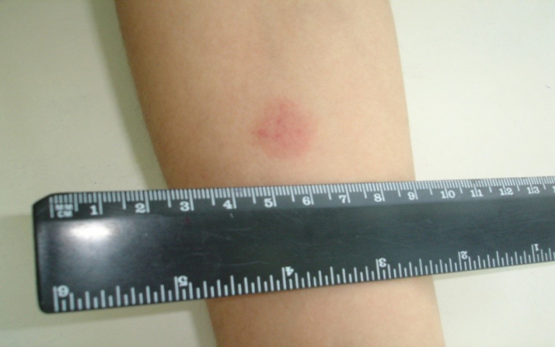 Манту у ребенка 9 мм 4 года фтизиатр ставит инфицирование thumbnail